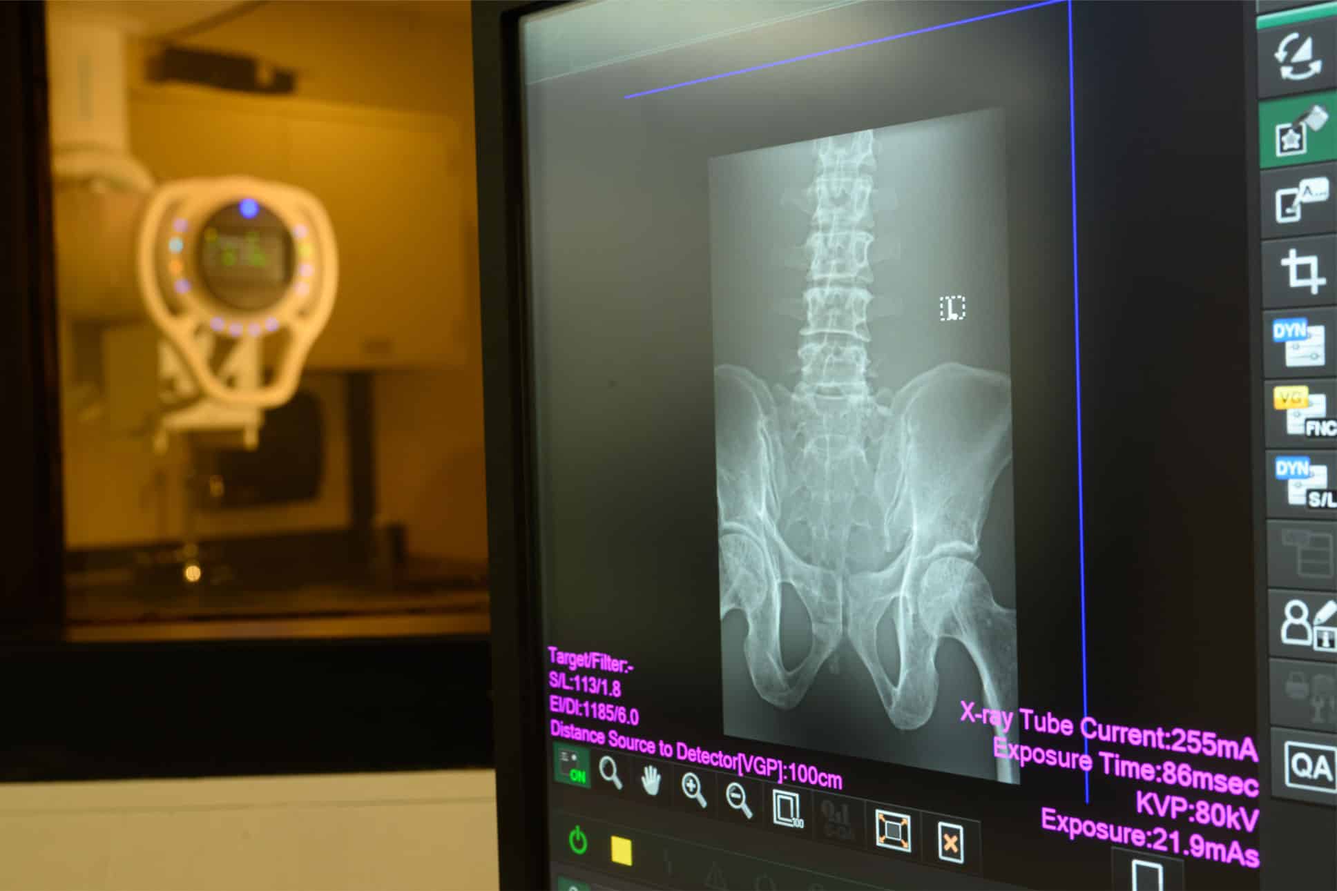 X‑ray image of a lower spine and pelvis displayed on a medical imaging monitor